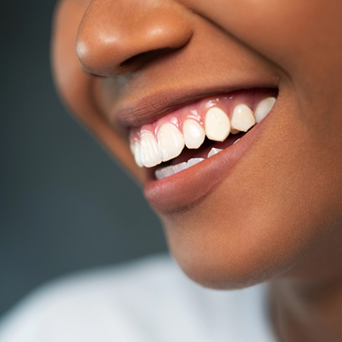Teeth Whitening